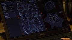 Consultant Neurosurgeon Erlick Pereira’s experience of surgical planning using Renishaw’s neuroinspire software